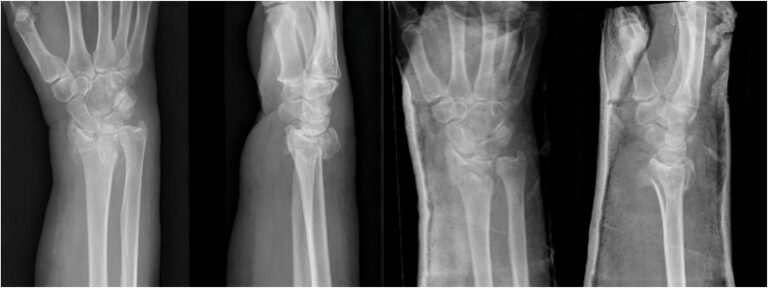 Real wrist radiographs showing a displaced distal radius fracture in an elderly patient profile.